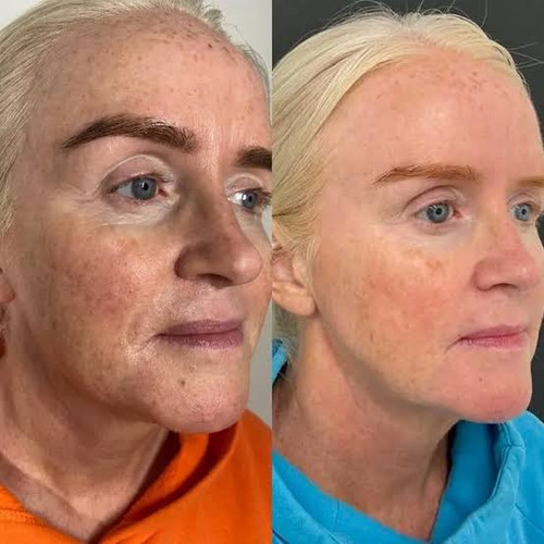 Best service for i-Pixel Laser Resurfacing in Baker Street.jpg