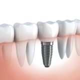 Dental Implants Plainview