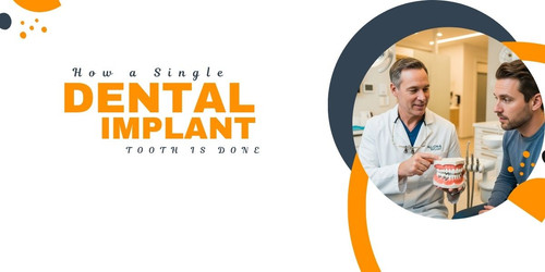 How a Single Dental Implant Tooth is Done.jpg