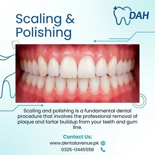 scaling and polishing lahore.png