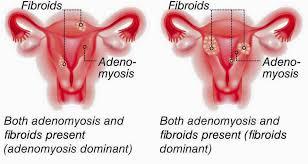 Fibroid Surgery.jpg