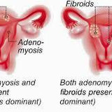 Fibroid Surgery