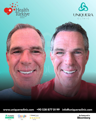 Organic Hair Transplant in Turkey for Natural Growth – Uniquera Clinic.jpg