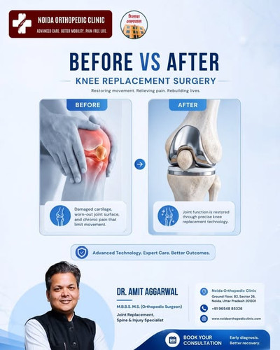 Knee Replacement Surgery Before vs After Restore Movement, Relieve Pain.jpg