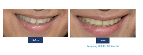 Dental Veeners.png