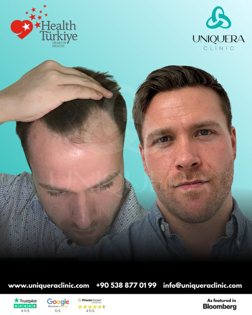 Expert Hair Transplant in Turkey for Permanent Natural Hair – Uniquera Clinic.jpg
