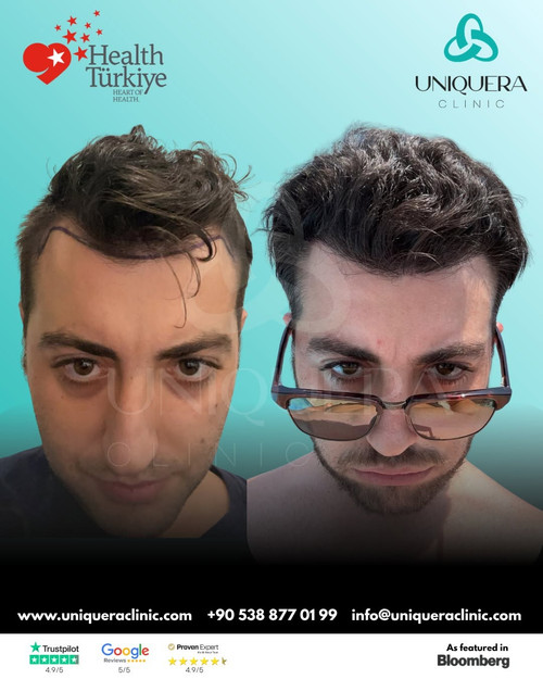 Best Sapphire FUE Hair Transplant in Turkey for Natural Results – Uniquera Clinic.jpg