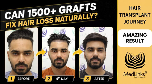 Best Hair Transplant in Delhi for Natural-Looking Results.jpg
