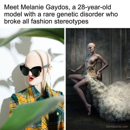 model genetic disorder ectodermal dysplasia melanie gaydos.jpg