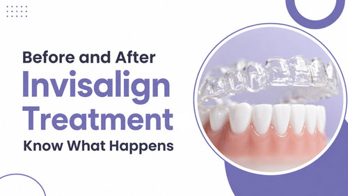 Before and After Invisalign Treatment Know What Happens.jpg