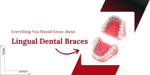 Everything You Should Know About Lingual Dental Braces.jpg