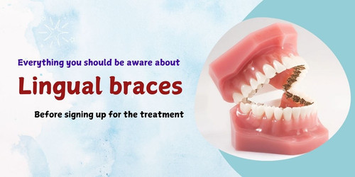 Everything you should be aware about lingual braces before signing up for the treatment.jpg