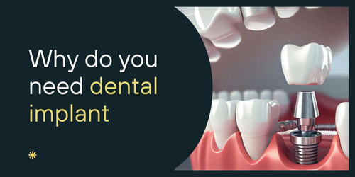 Why do you need dental implant.jpg