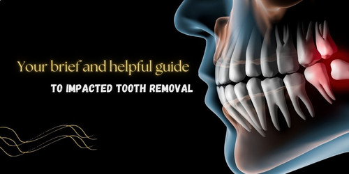 Your brief and helpful guide to impacted tooth removal.jpg