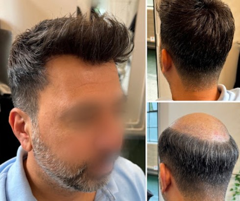 Best treatment for Non Surgical Hair Replacement in Stratford.jpg