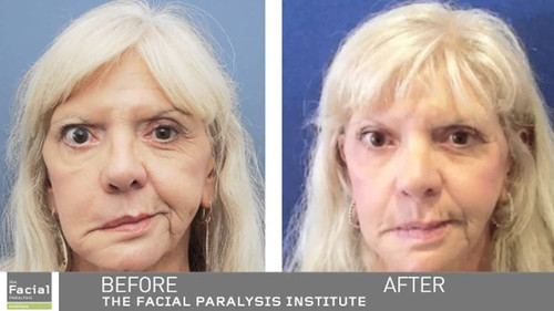 Facial Paralysis Treatment.jpg