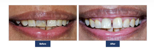 Teeth whitening.png