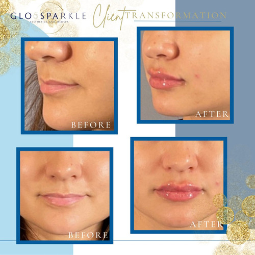 Non-Surgical BBL Lubbock TX.jpg