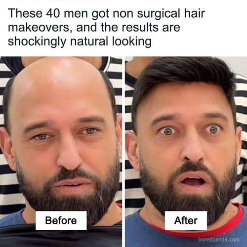 hair baldness before after makeovers.jpg