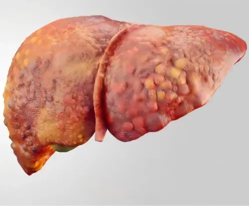 NAFLD (1).webp