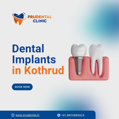 Dental Implants in Kothrud.jpg