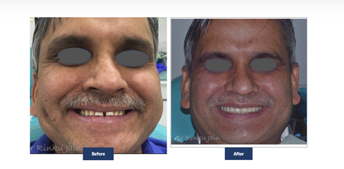 Full Mouth Restoration.png