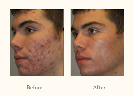 Acne Treatment.png