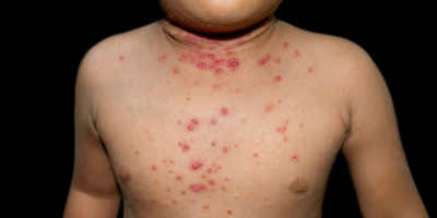 Criança com lesões de molusco