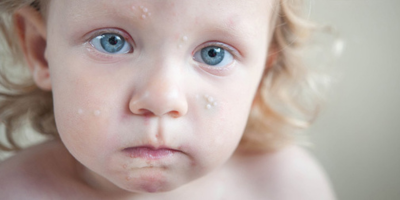 Pele de criança com molusco