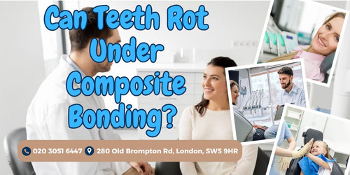 Can Teeth Rot Under Composite Bonding Here's What to Know.jpg