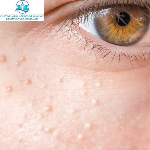 Get Clear Skin with Expert Milia Extraction Treatment Nearby.jpg