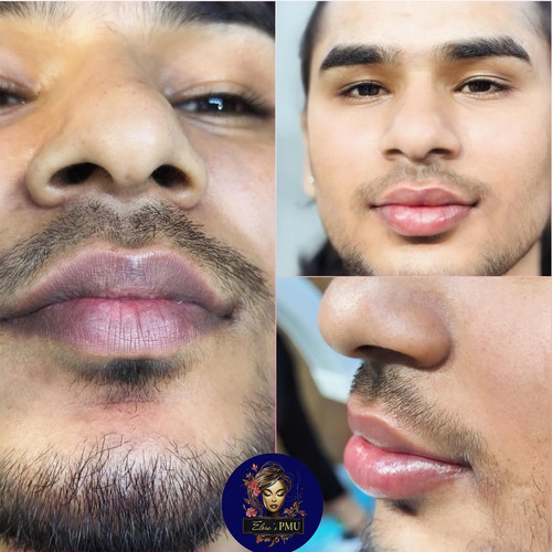Dark lips correction treatment in delhi.jpg
