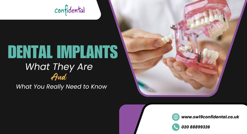 Dental-Implants-What-They-Are-and-What-You-Really-Need-to-Know.png