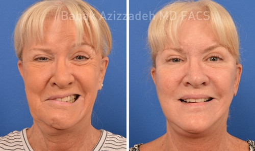 Facial Reanimation.jpg