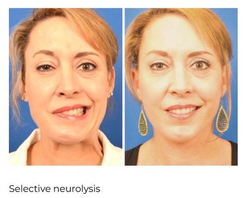 Bell's Palsy Surgeon.jpg