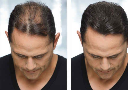 Breakthrough Hair Loss Treatment in Juhu – Only at Skinworks.png