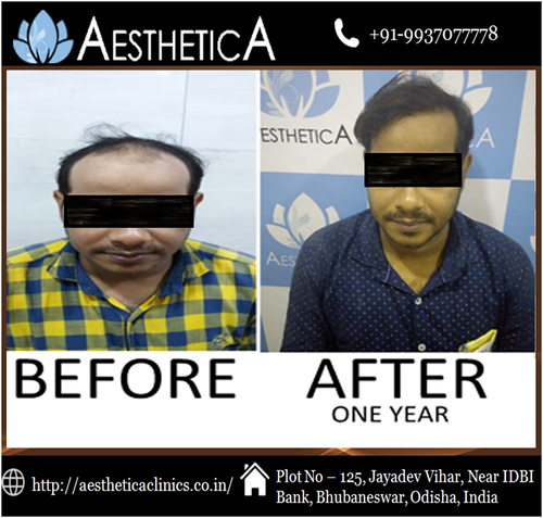 Best Hair Transplant1.png