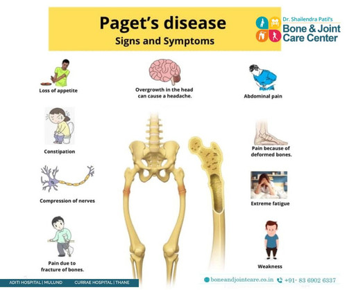 Orthopedic Doctor In Mulund on Paget disease.jpg