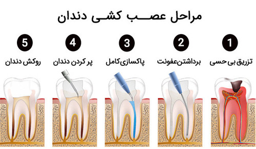 root canal 03.jpg