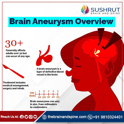 Brain Aneurysm overview.jpg