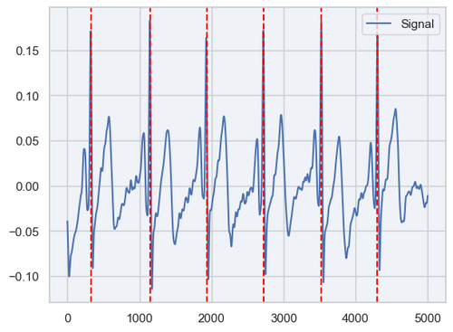 r peak detection image.png