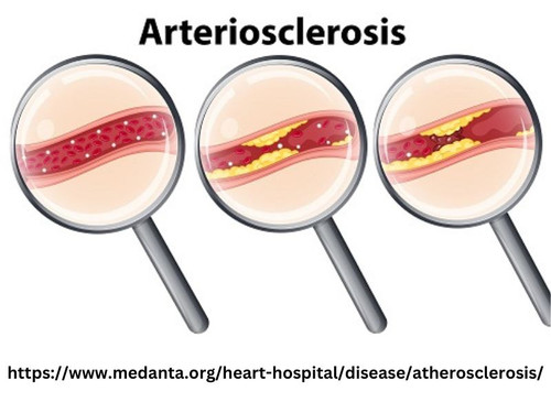 Arteriosclerosis (2).jpg