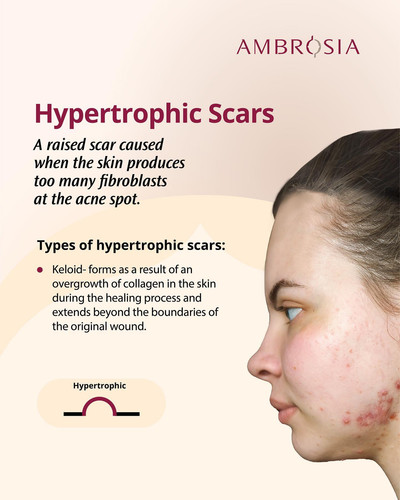 Hypertrophic Scars.jpg
