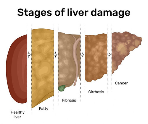 liver damage.jpg