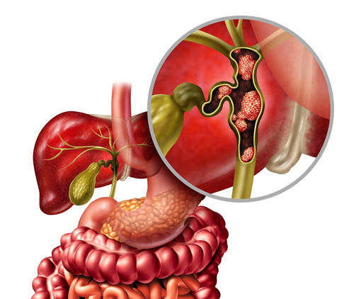 Cholangiocarcinoma (bile duct cancer) | Medanta Cares.jpg