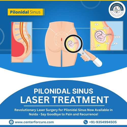 Pilonidal Sinus Laser Surgery in Noida.jpg