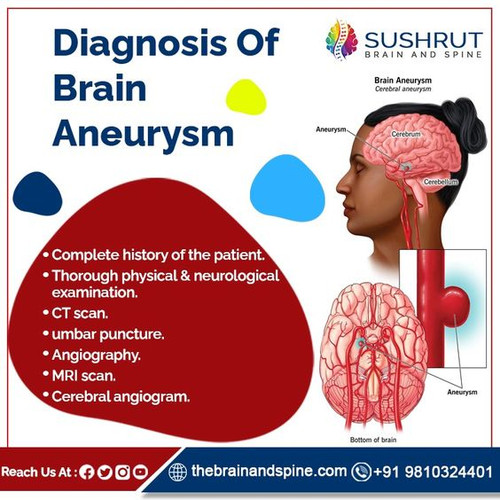 Diagnosis Of Brain Aneurysm.jpg