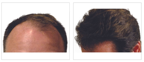 Robotic Hair Transplant Treatment in South bay.png