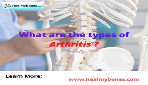 Heal My Bones: Learn Common Types of Arthritis.jpg