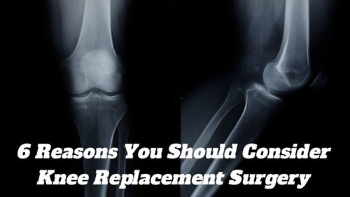 6 Reasons You Should Consider Knee Replacement Surgery.jpg